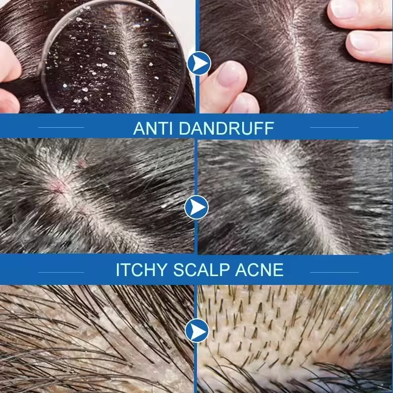 Szybkie mydło do włosów przeci – Hair Care Dandruff recenzja i cena
